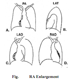 236_Explain Right Atrial Enlargement.png